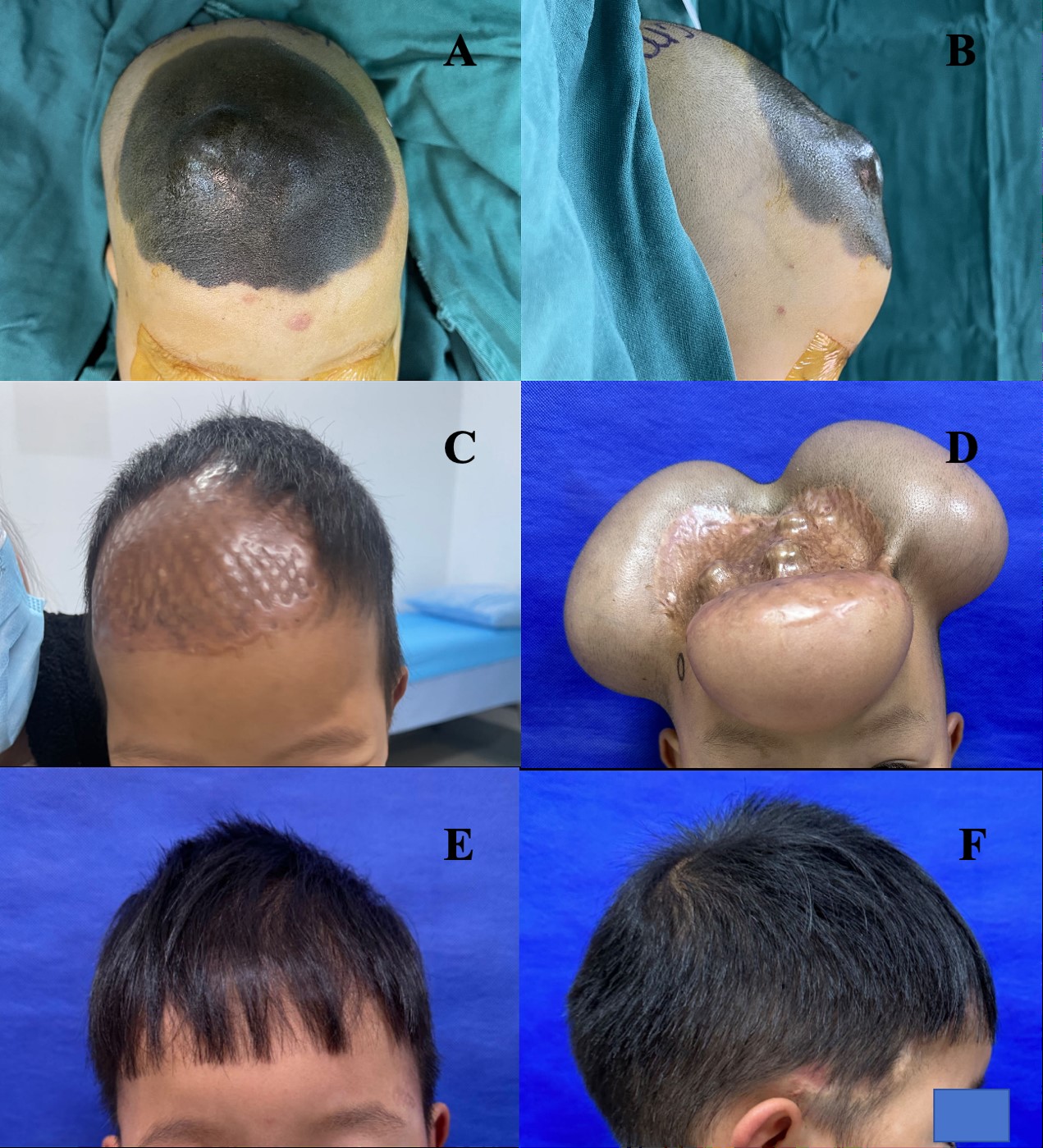melanotic nevi Moles (melanocytic naevi, pigmented nevi) Intradermal Nevus: Symptoms, Causes, and